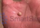 All you need to know about tonsil stones, the peculiar growths resembling pimples in your throat.